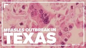 West Texas Measles Outbreak Claims Two Lives