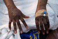 Three new mpox cases in Ekurhuleni, bringing total in SA to 31