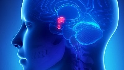 Sheehan Sendromu Nedir? Doğum Sonrası Kanamaya Bağlı Hipofiz Doku Ölümünün Belirtileri Nelerdir? Nasıl Tedavi Edilir?