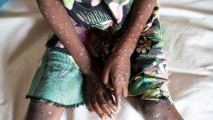 First US Case Of Severe Mpox Strain Confirmed