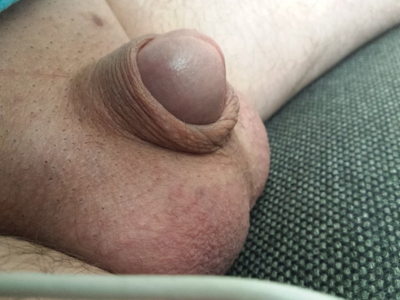 Mikro penis örneği.