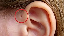 Preauriküler Sinüs nedir?