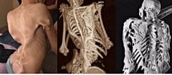 Taş Adam Sendromu (Fibrodysplasia Ossificans Progressiva)