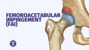 Comparative Study Reveals Insights On FAI Treatment Strategies