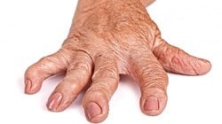 Artrit Nedir? Eklem Kireçlenmesi Tedavi Edilebilir mi?