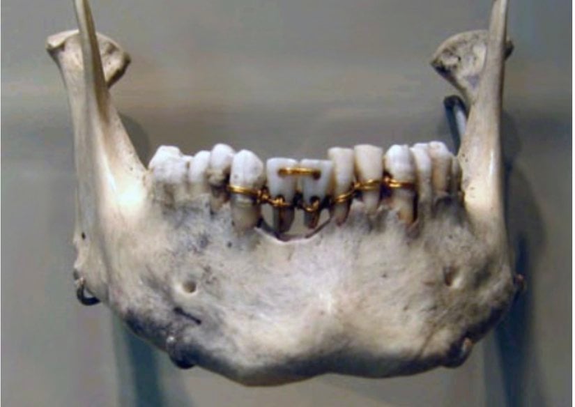 Antik Mısır'dan Kalma Bir Diş Tedavisi