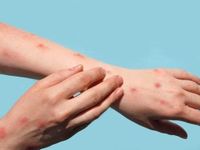 Health dept says 'ongoing local transmission of mpox' in Gauteng as more cases reported | The Citizen