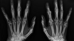Bebeklikten Yetişkinliğe Ellerimizin X-Işını Görüntüsü ve Kemik Yaşı