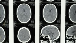 Yarı Beyinle Yaşamak | Hemispherektomi