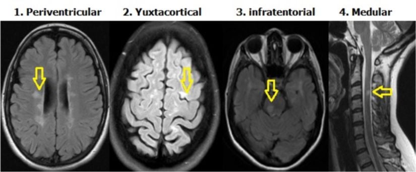 MS lezyonlarının beyin ve omurilikte okla gösterildiği MR görüntüleri