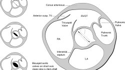 Biküspit Aort Kapak