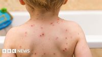 Children offered chickenpox vaccine on NHS