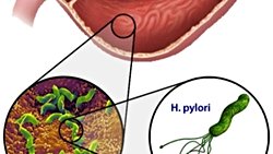 Helikobakter Pilori nasıl teşhis edilir?