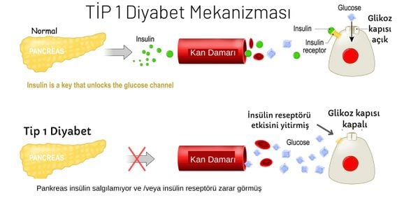 Tip 1 diyabet