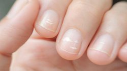 Tırnaklardaki beyaz lekeler neden bazen oluşup kaybolur?