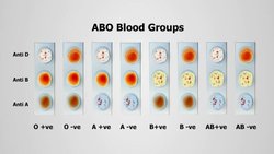 İNSAN KAN GRUPLARI VE KLİNİK ÖNEMİ