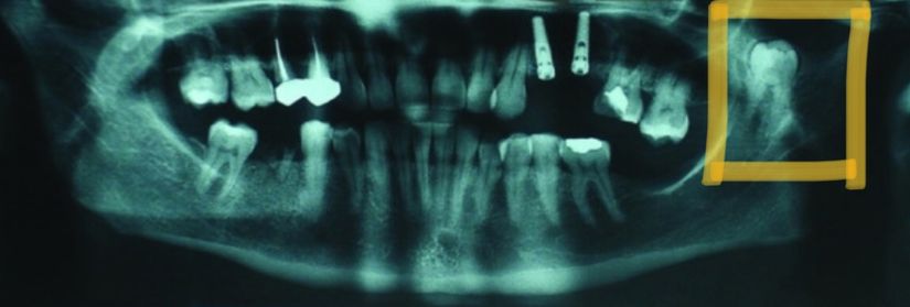 Sol alt çenede (sarı kutu içerisinde) mandibular koronoid processte sürmüş ektopik bir 20 yaş dişi