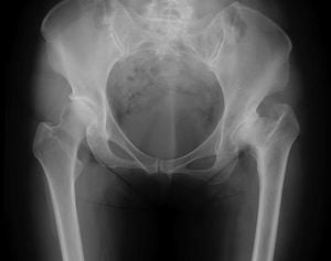 Study Finds Leg Length Variations Impact Hip Surgery Outcomes