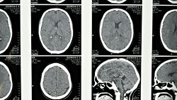 Yarı Beyinle Yaşamak | Hemispherektomi