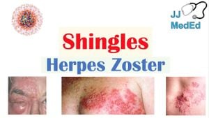 New Model Predicts Herpes Zoster Risk Through Gene Analysis