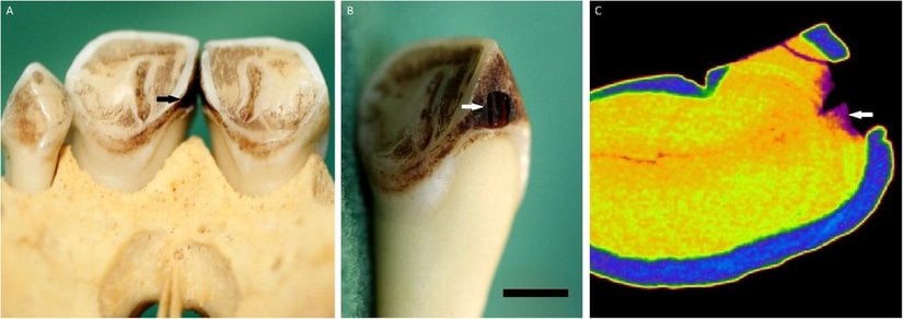 Bir Mona maymununun üst sağ orta keser dişinde izlenen çürük