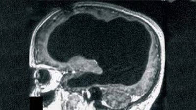 Beyninin %90'ı Hasar Görmüş Bir Adam, 