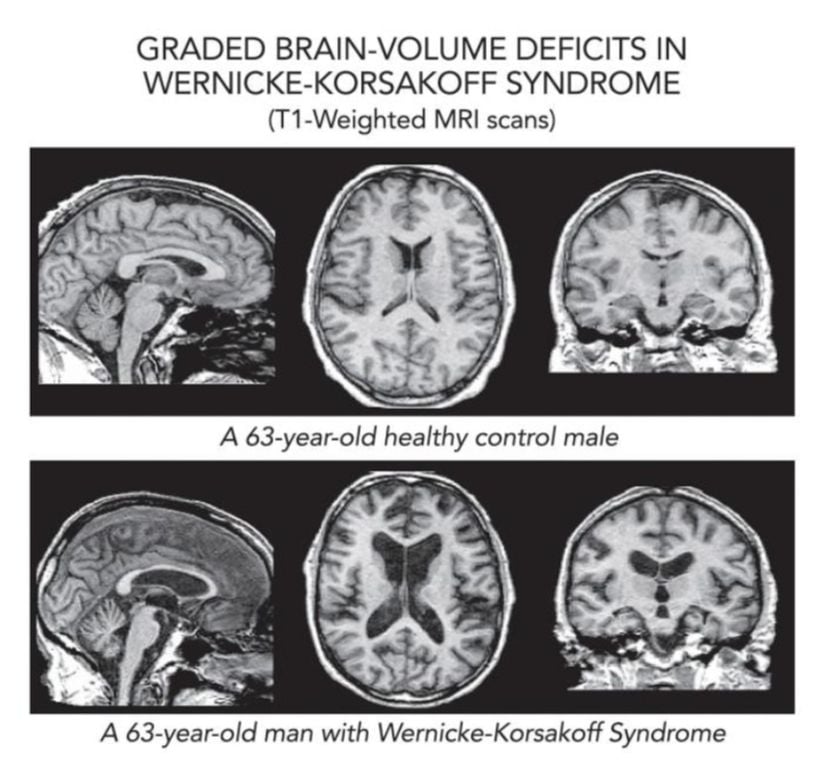 Sağlıklı bir erkeğin (üstte) manyetik rezonans görüntüleme (MRI) taramaları, WK sendromlu aynı yaştaki bir erkekle (altta) karşılaştırılmıştır. WK beyni daha az beyin hacmine ve beyin içinde daha büyük boşluklara (ventriküller olarak adlandırılır) sahiptir.