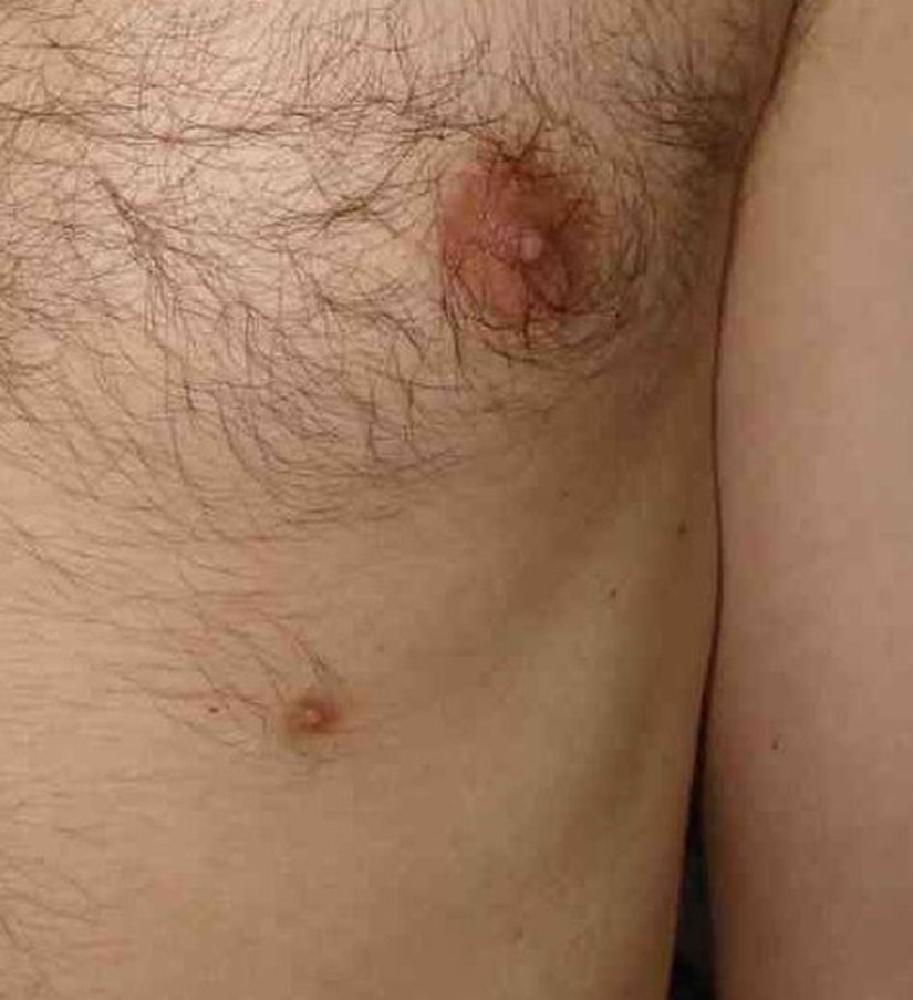 Supernumerary Nipple on Biological Male