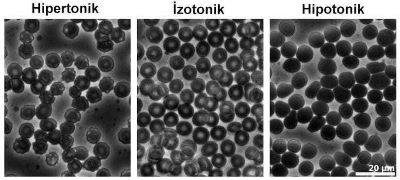 İnsandaki kırmızı kan hücrelerinin (eritrositlerin) farklı&nbsp;ortamlardaki halleri. Hipotonik bir ortamda hücre, içerisine su alarak şişer ve bunu takiben patlayabilir.