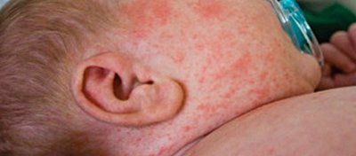 Dawson Hastalığı (Subakut Sklerozan Panensefalit)