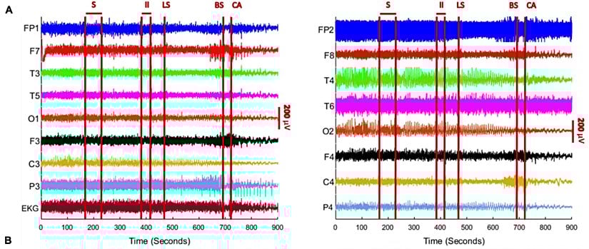 Bu grafikte, sol taraftaki grafik sol beynin, sağ taraftaki grafik sağ beynin faaliyetini göstermektedir. Bu grafikler, her iki tarafta 8'erden toplam 16 ayrı elektrottan gelen elektrik sinyalleri yansıtmaktadır. Grafikte, en altta EKG olarak isimlendirilmiş grafik ise hastanın kalbinden toplanan sinyallerdir. Grafiklerde zaman, soldan sağa doğru akmaktadır.
