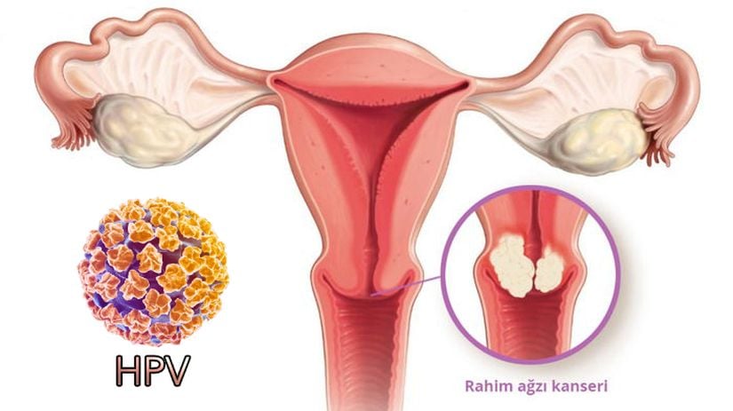 Serviks (rahim ağzı) kanseri sebebi olabilen virüs.
