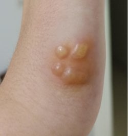 Zona -halk arasında gece yanığı- enfeksiyonu neden ve nasıl oluşur? Nasıl tedavi edilir?