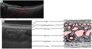 Choroidal Thickness May Signal Early Cardiovascular Risks For Type 1 Diabetics