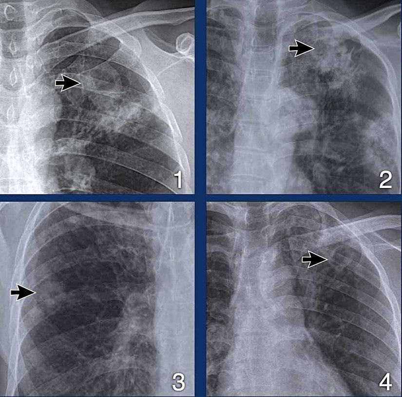 Aktif TB hastalarının yaklaşık yarısında kavitasyon görülür. Bu hastalar yüksek bakteri yüküne sahiptir ve oldukça bulaşıcıdır.