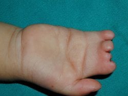 Cinsiyet kromozomlarındaki Y'nin X ile homolog olmayan bölgedeki hastalıklar?