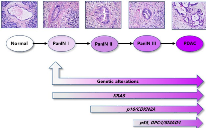 PDAC gelişimindeki patolojik aşamalar ve düzensiz moleküler olaylar