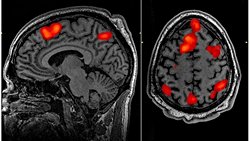 Ölürken EEG'si Çekilen Hasta