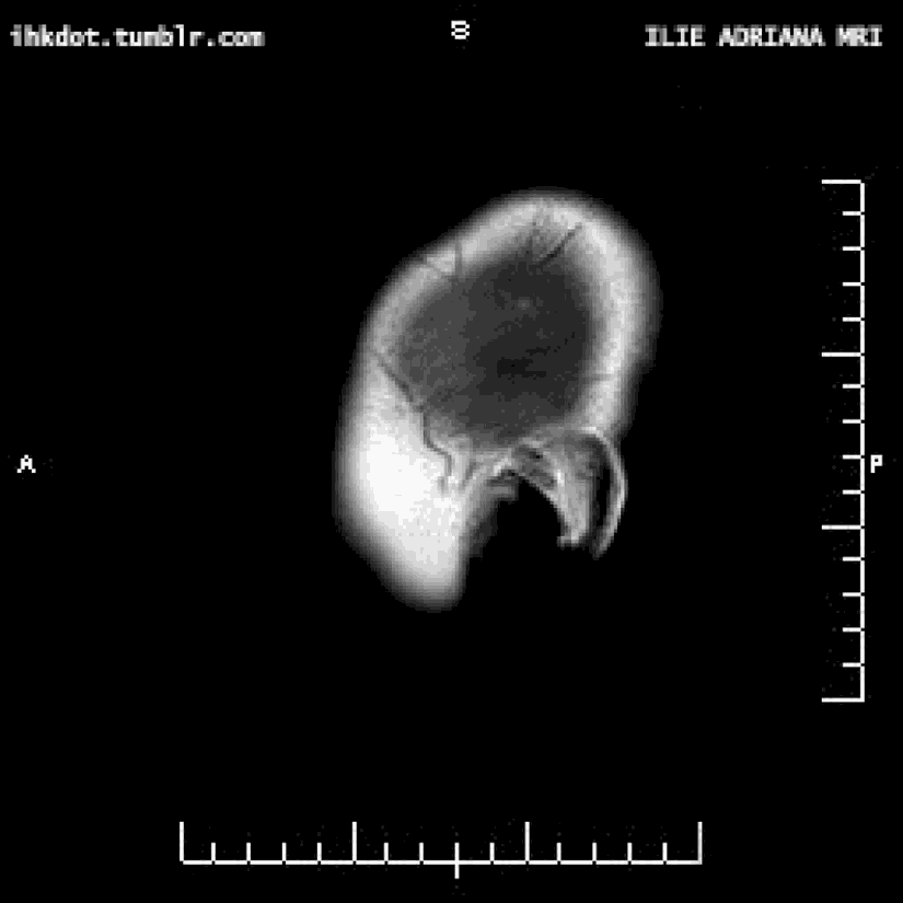 MRI cihazıyla beynimizi tararken, onu tıpkı Düzlemler Ülkesi'ndeki 2 boyutlu varlıkların 3 boyutlu cisimleri deneyimlediği gibi, katman katman deneyimleriz.