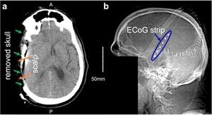 Automated Machine Learning Model Detects Brain Injury Signals