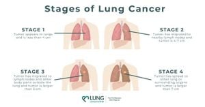 New Study Reveals MiR-224's Role In Lung Cancer Progression