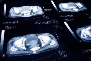Outdated Guidelines Spur Prostate Cancer Overtreatment Crisis