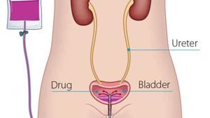 Intravesical Chemotherapy Between TURBTs Improves Bladder Cancer Outcomes