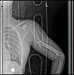 Ağır travma sonrası şiddetle kırılan kemikler asla eskisi gibi olmaz mı yoksa tamamen iyileşmeyi başarırlar mı?