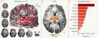 A generalized epilepsy network derived from brain abnormalities and deep brain stimulation - Nature Communications