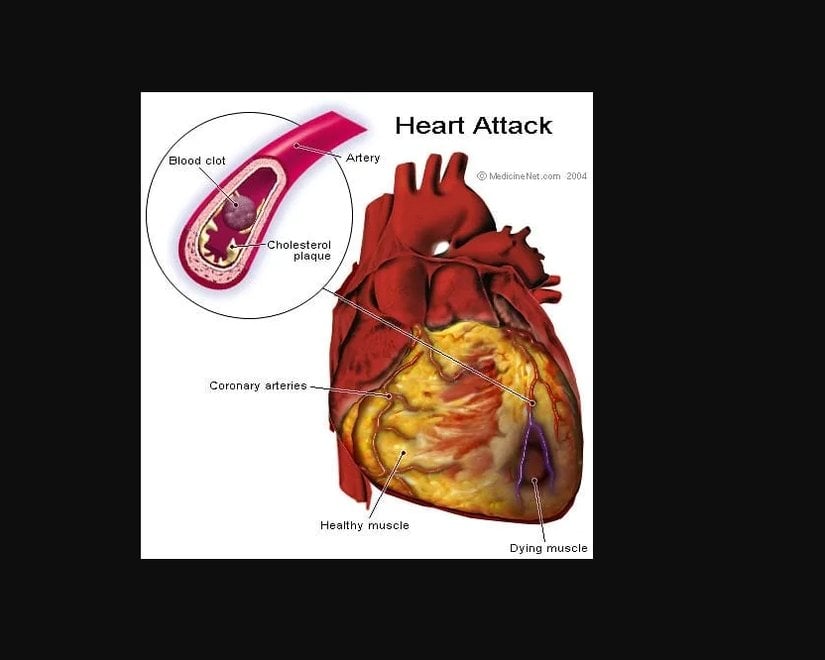 Kalbi besleyen koroner arterlerin tıkanıklığı