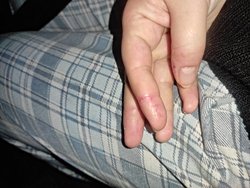 Tırnak etlerimi yememek için ne yapmalıyım?