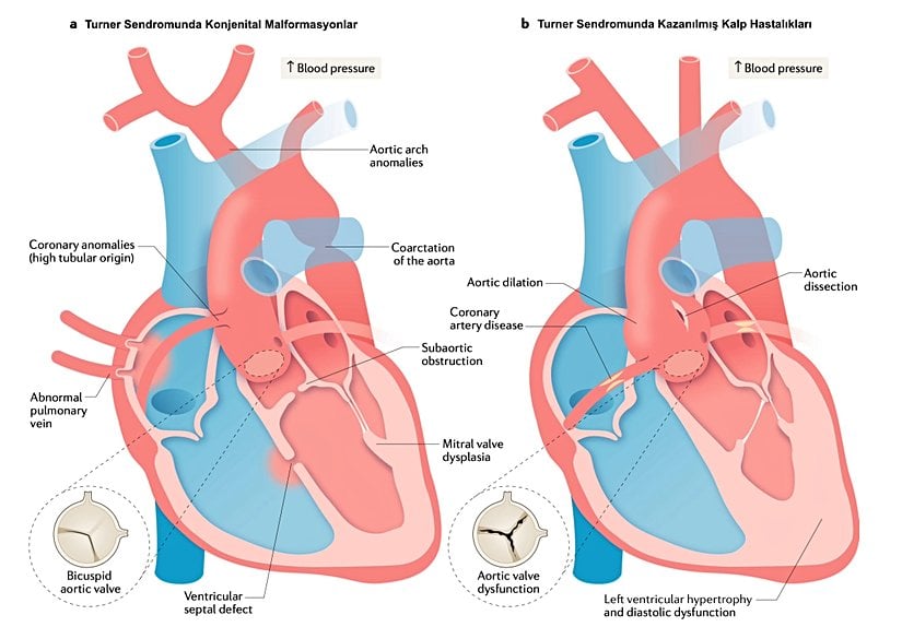 Turner Sendromunda konjenital ve kazanılmış kardiyak problemler. Kazanılmış kalp hastalıkları sıklıkla, konjenital malformasyonların üstünde meydana gelir. Örneğin, solda görülen biküspit aort kapağının mevcudiyeti aort dilatasyonu riskini artırır. Aort genişlemesi yetişkin yaşamı boyunca meydana gelir ve normals sınırı aşarsa aort diseksiyonunun öncüsü olabilir.