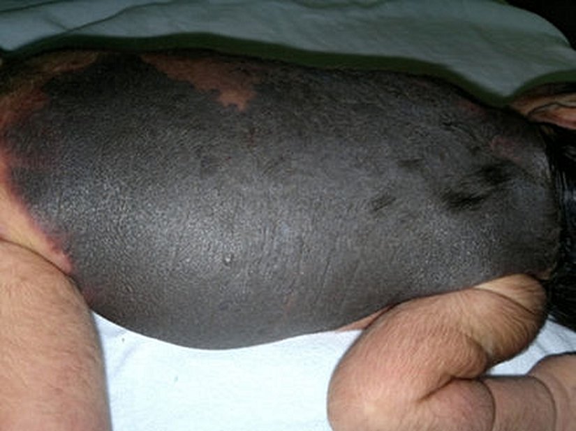 Giant congenital melanocytic nevus