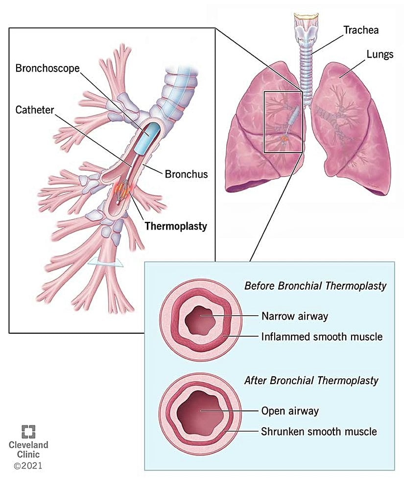 Bronşiyal termoplasti, astım semptomlarını azaltmak için akciğerlerdeki düz kasları küçültmek için ısı kullanır.